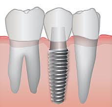 dental implants moreno valley ca